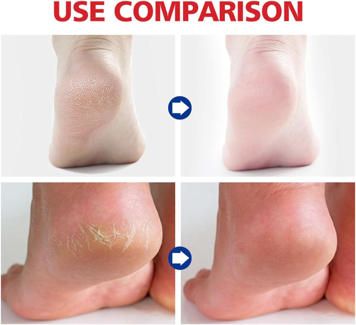 Foot Cream for Cracked Heels