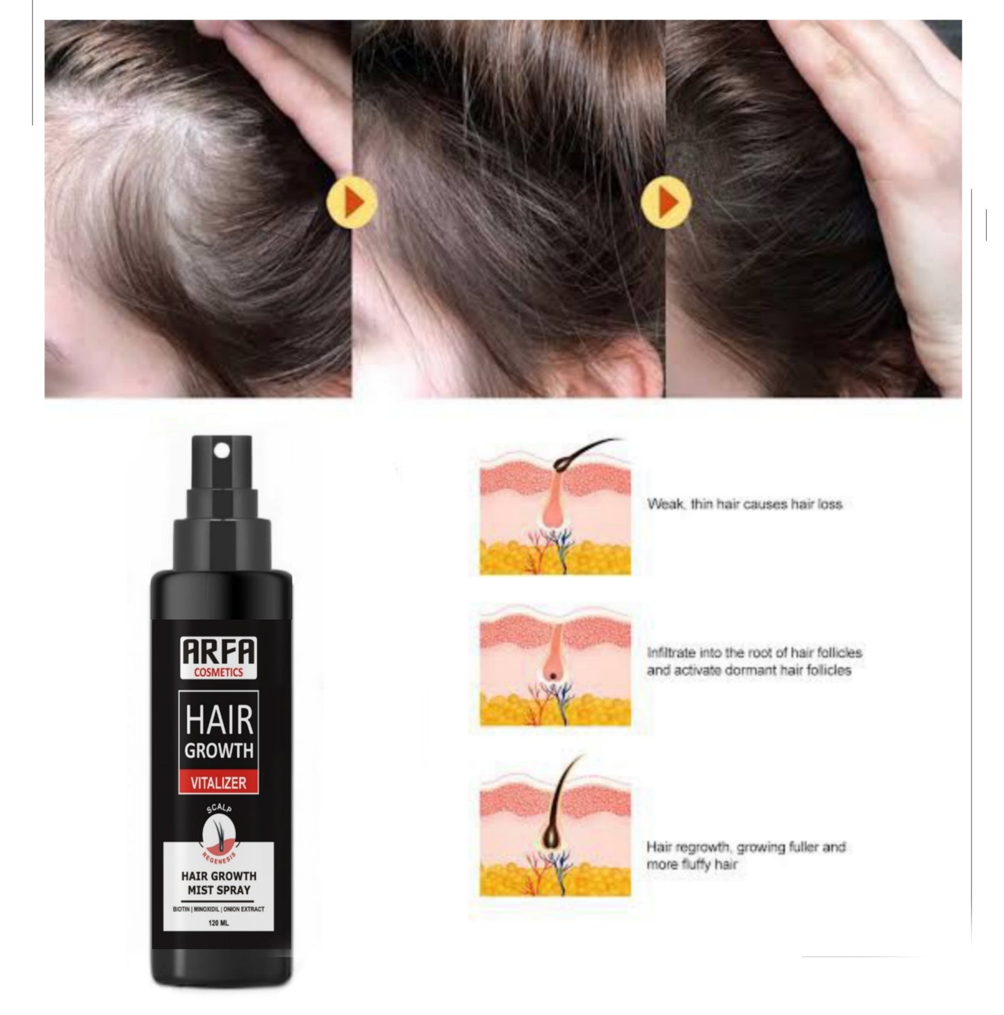 FORT Minoxidil Hair Growth Spray