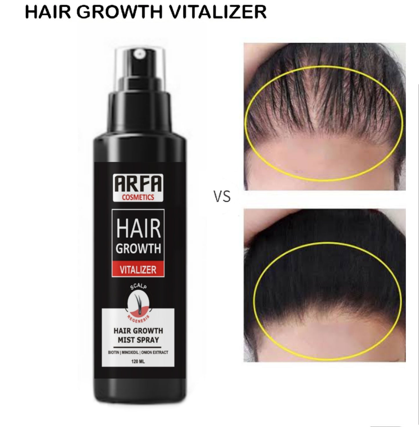 FORT Minoxidil Hair Growth Spray
